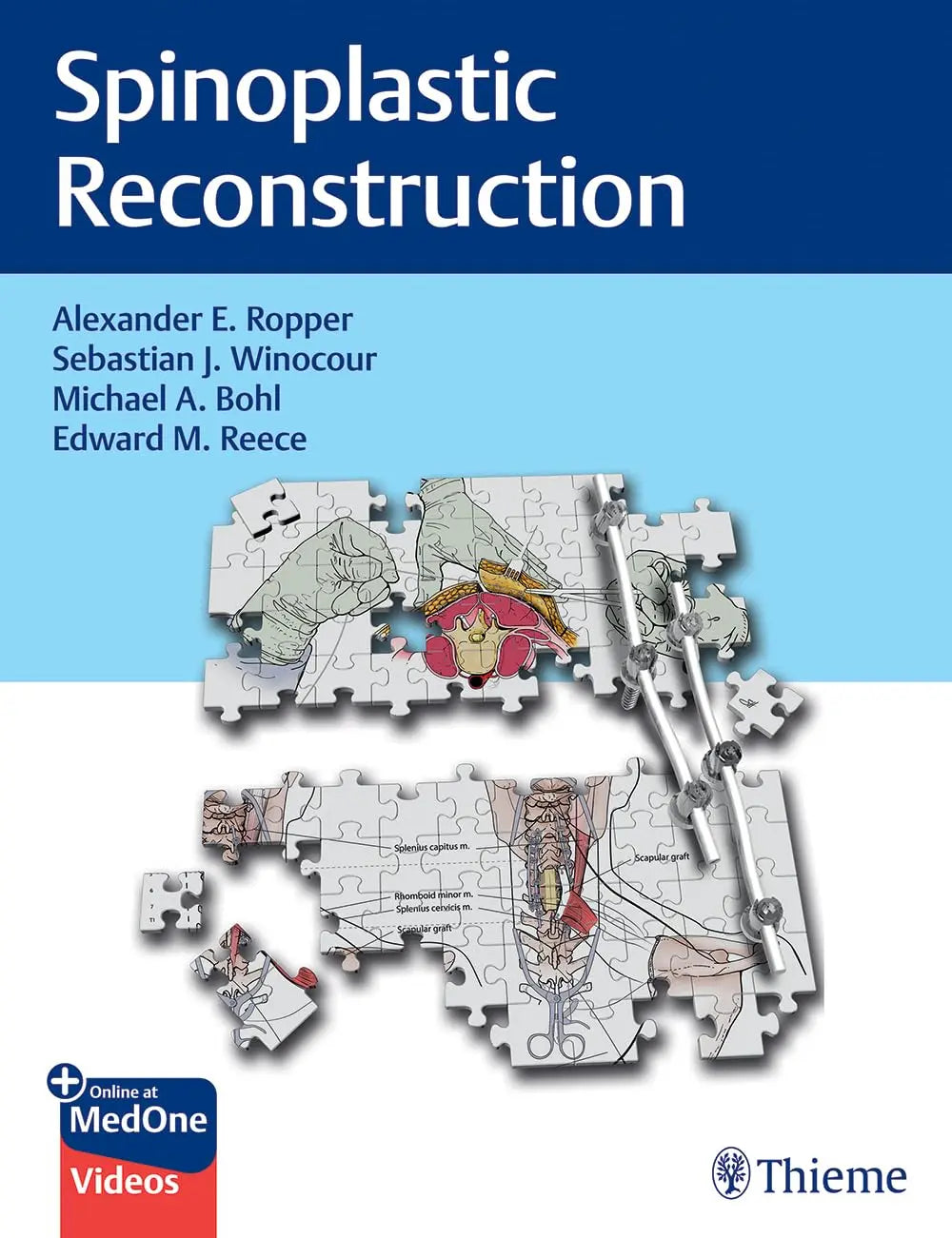 Spinoplastic Reconstruction 2024