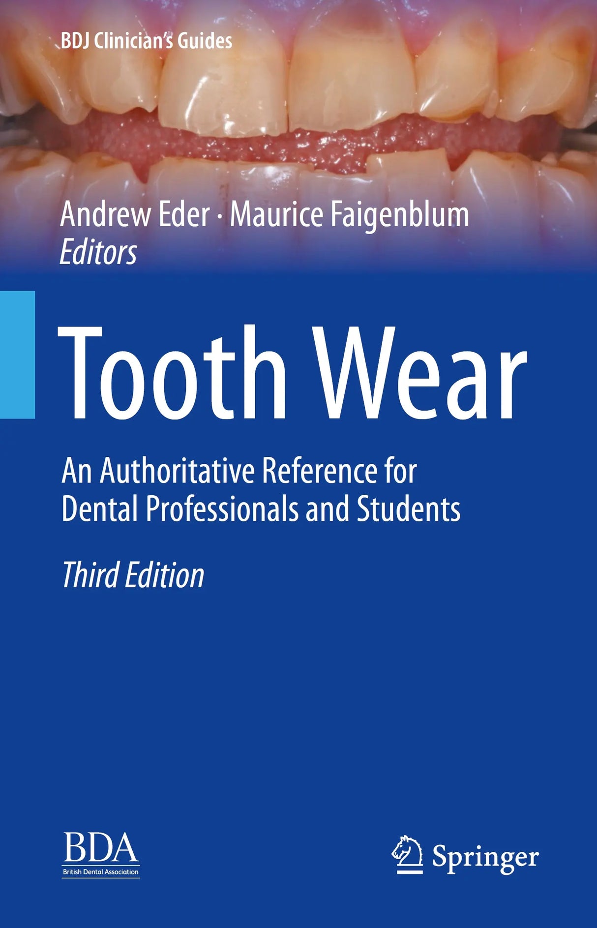 Tooth Wear An Authoritative Reference for Dental Professionals and Students 2022