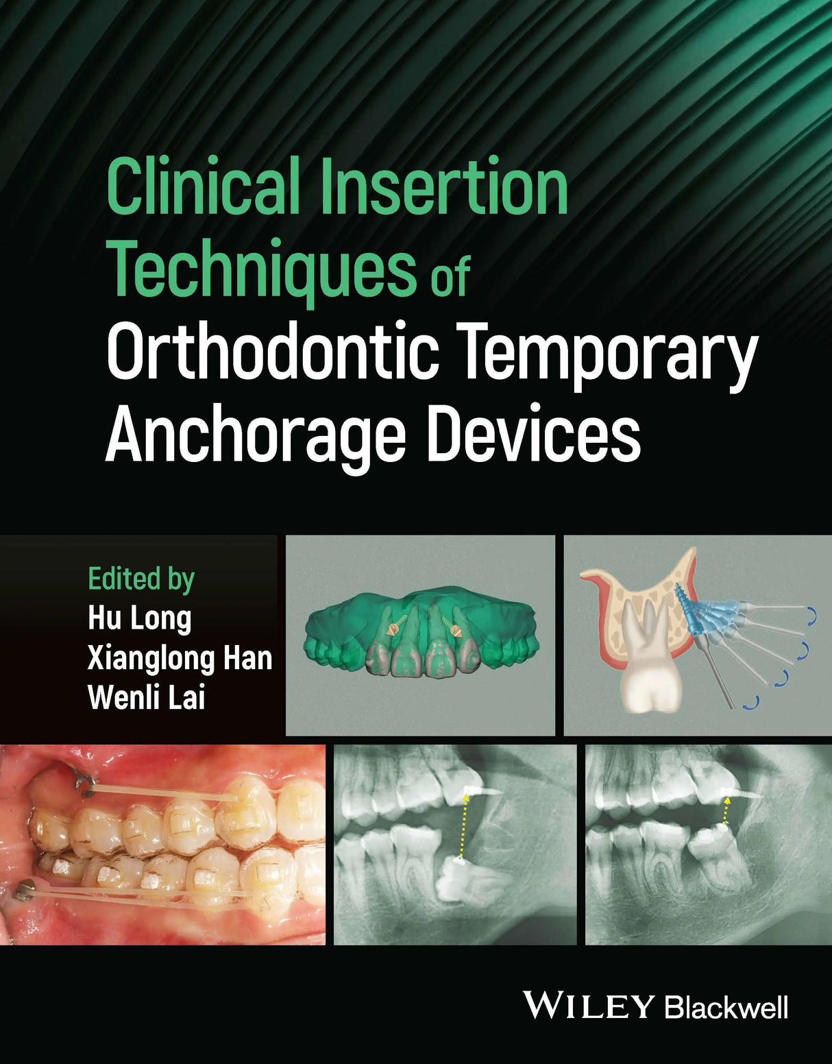 Clinical Insertion Techniques of Orthodontic Temporary Anchorage 2024