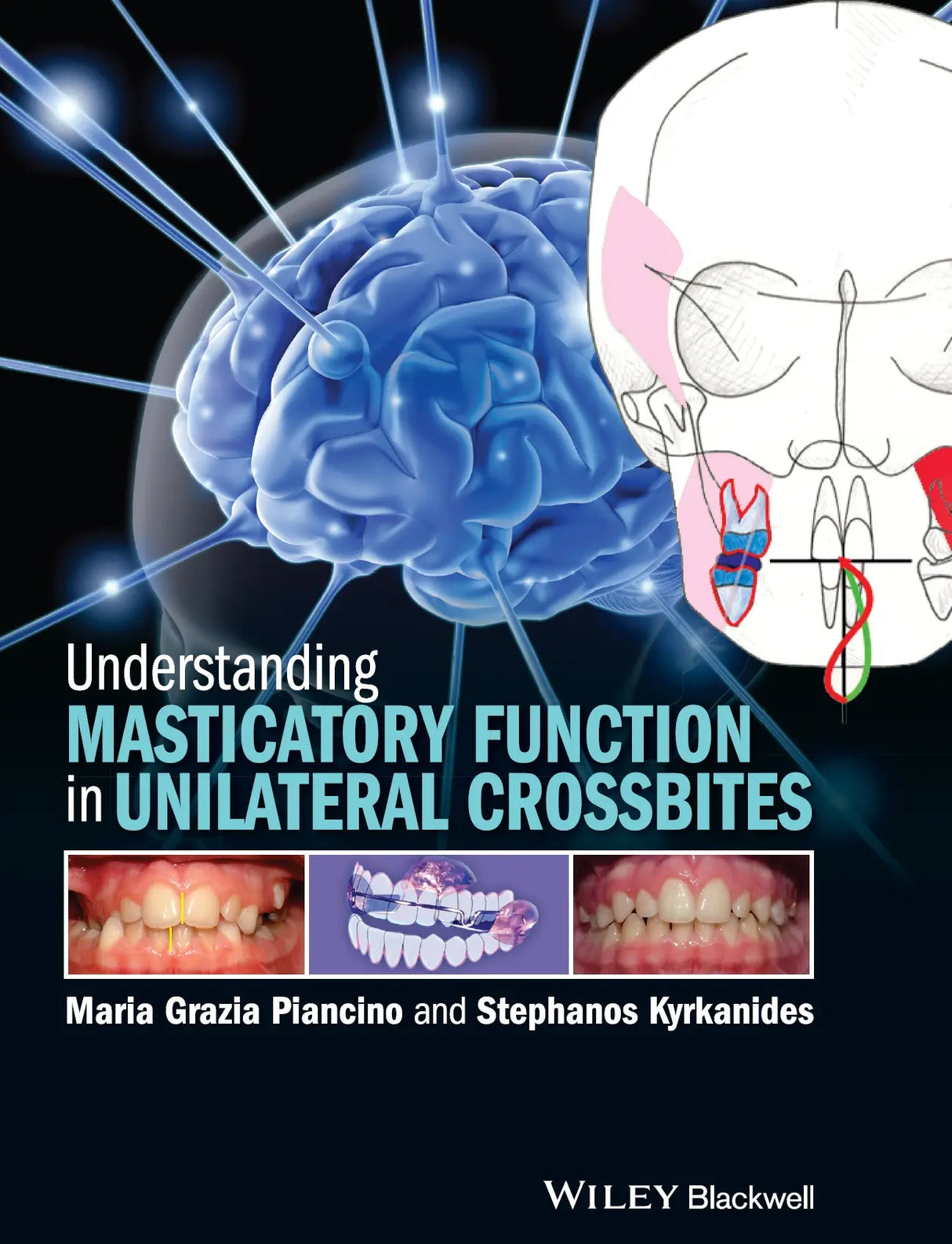 Understanding Masticatory Function in Unilateral Crossbites 2016