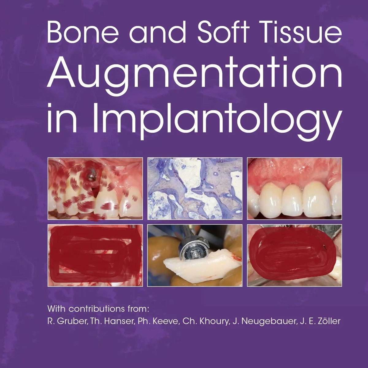 Bone and Soft Tissue Augmentation in Implantology 2022 – MedSTA