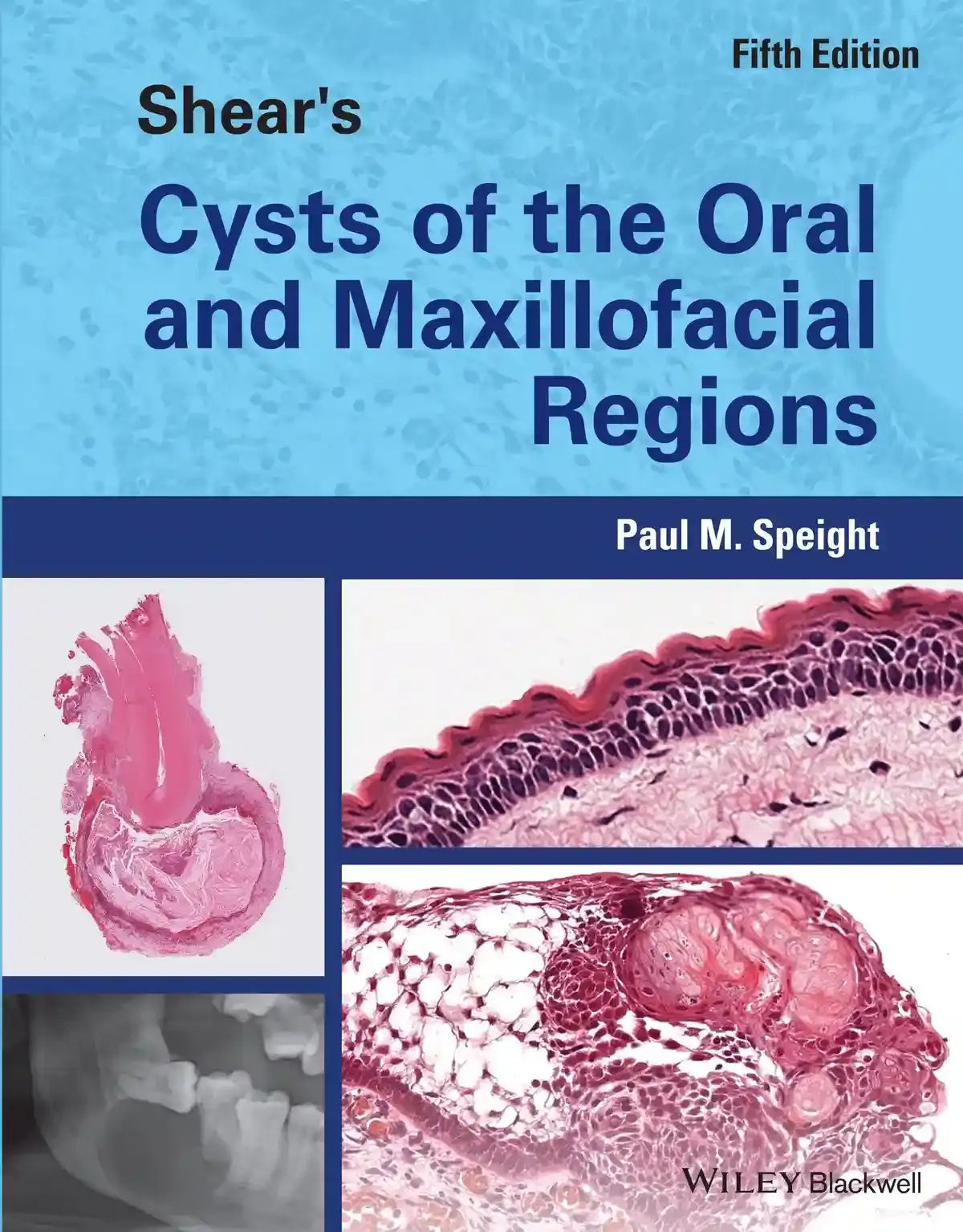 Shear’s Cysts of the Oral and Maxillofacial Regions 2022