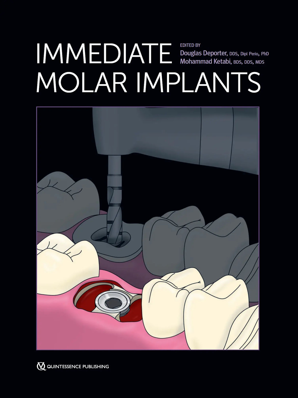 Immediate Molar Implants 2023