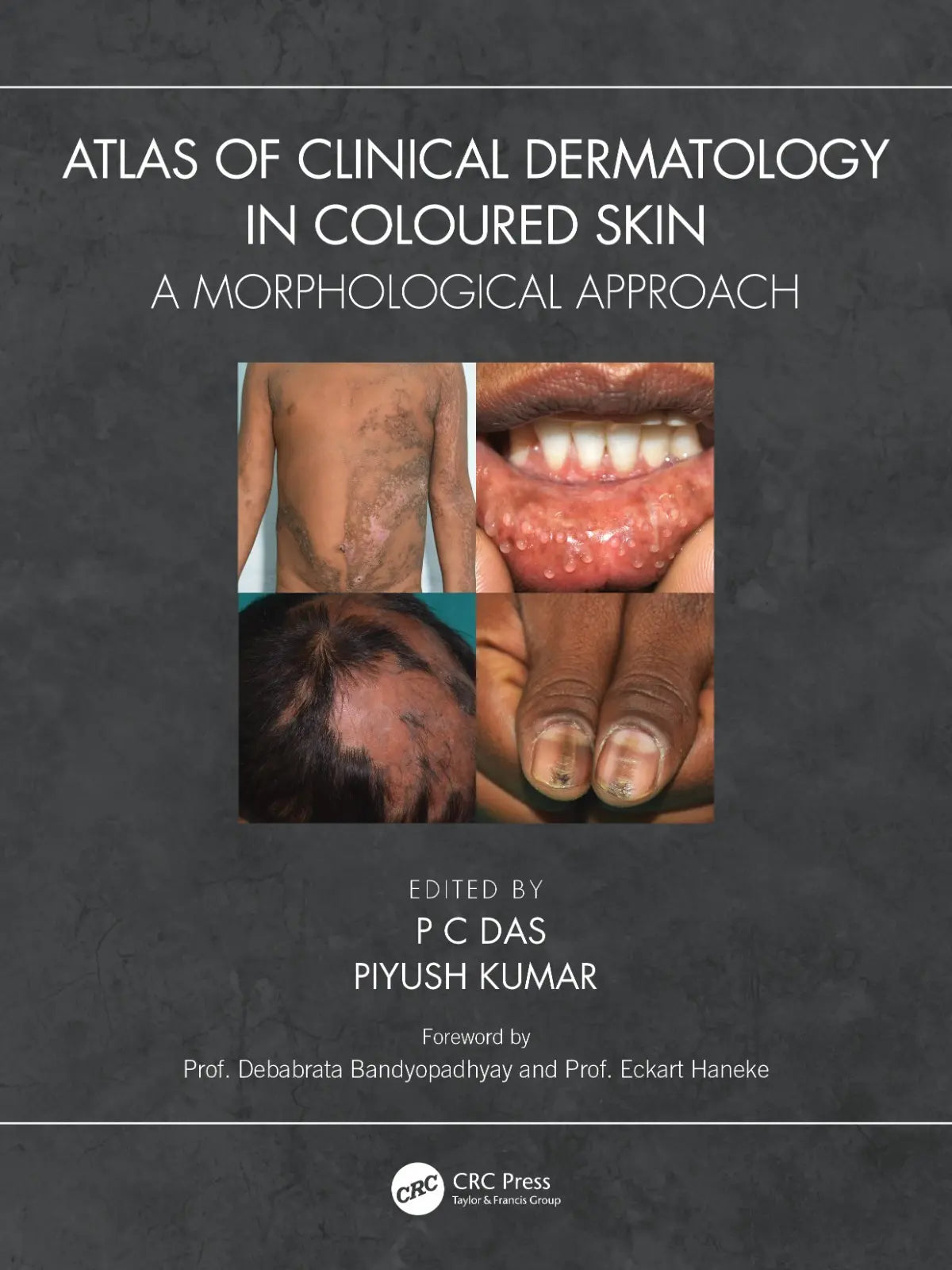 Atlas of Clinical Dermatology in Coloured Skin A Morphological Approach 2023