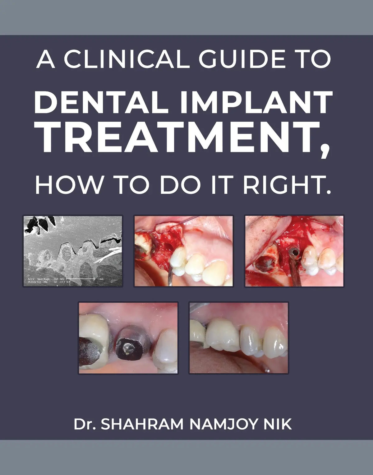 A Clinical Guide to Dental Implant Treatment How to do it right 2025