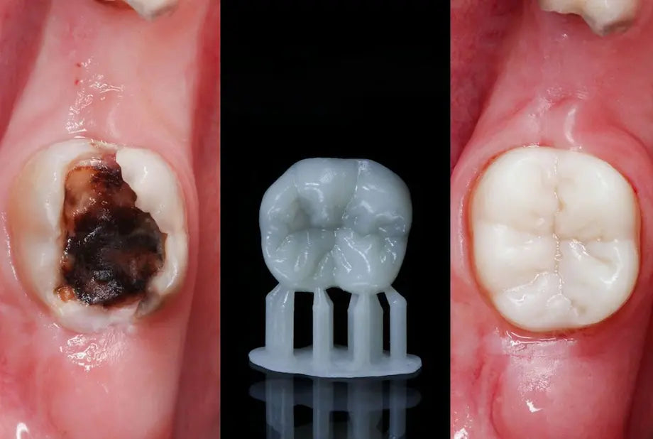 3D-Printed Permanent Restorations: Clinical Reality, Decision-Making, and Risk Management in Modern Prosthodontics