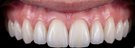 Management of White Spot Lesions: A Guide to Clinical Excellence