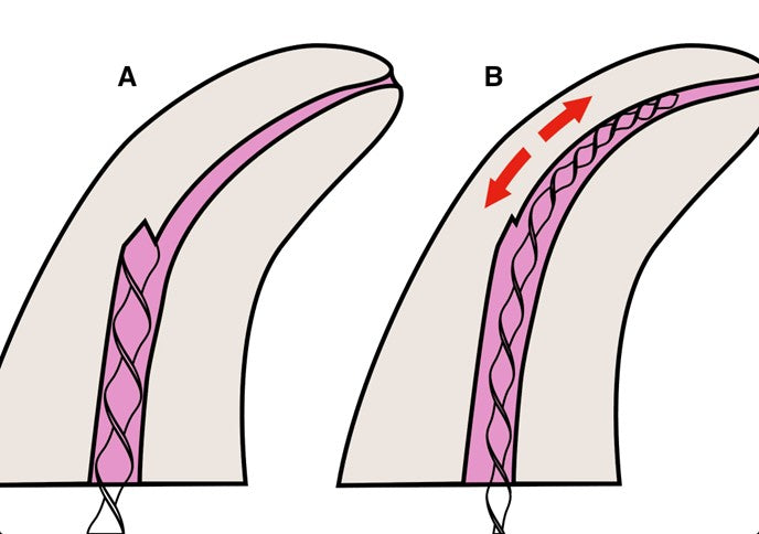 Clinical Review: Management and Bypassing of Root Canal Ledges