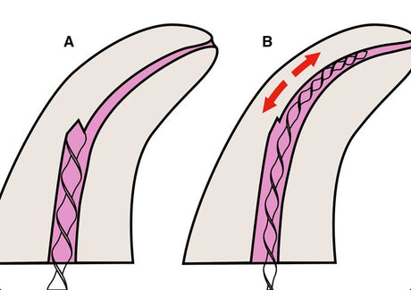 Clinical Review: Management and Bypassing of Root Canal Ledges