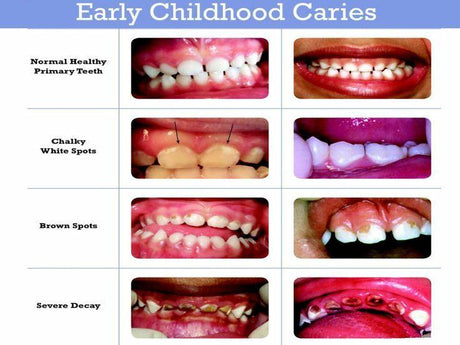 Early Childhood Caries: Causes, Stages, Diagnosis & Prevention