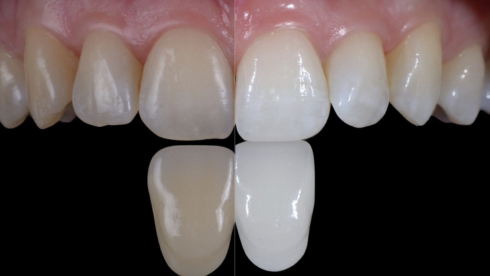 Professional Teeth Bleaching: Evolution and Clinical Standards in 2026