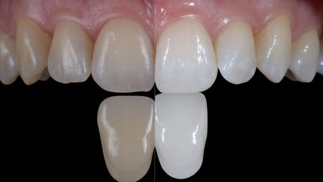 Professional Teeth Bleaching: Evolution and Clinical Standards in 2026