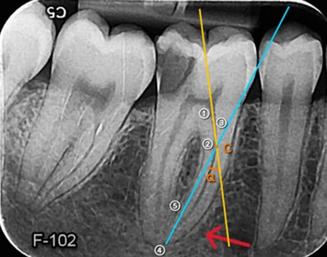 Preoperative periapical radiograph of a mandibular molar with the root canal curvature traced to assess endodontic file separation risk before instrumentation