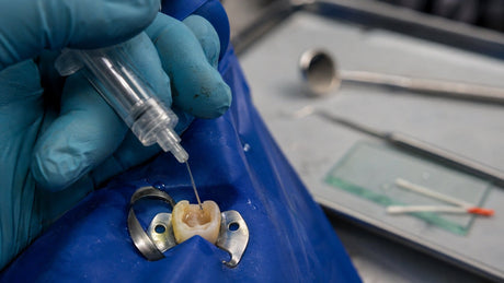 Dentist performing root canal irrigation with a side-vented syringe on an isolated molar using a blue rubber dam during endodontic treatment.