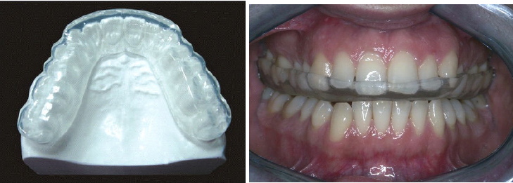 Splints in Traumatic Dental Injuries in children