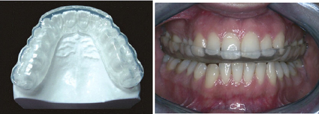Splints in Traumatic Dental Injuries in children