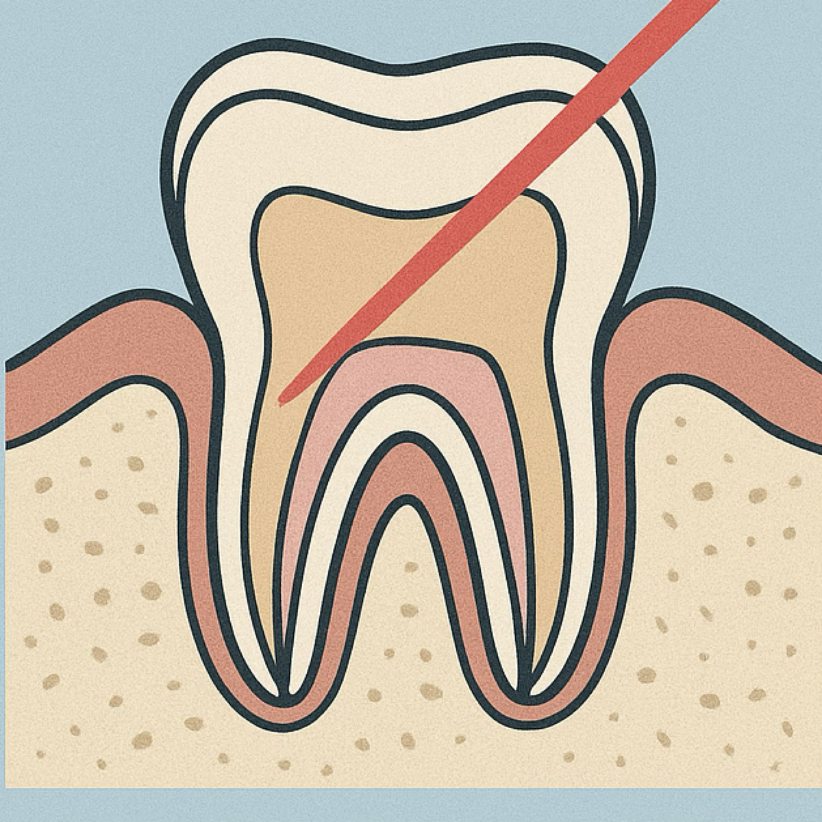 Laser in Vital Pulp Therapy: The New Clinical Standard – MedSTA