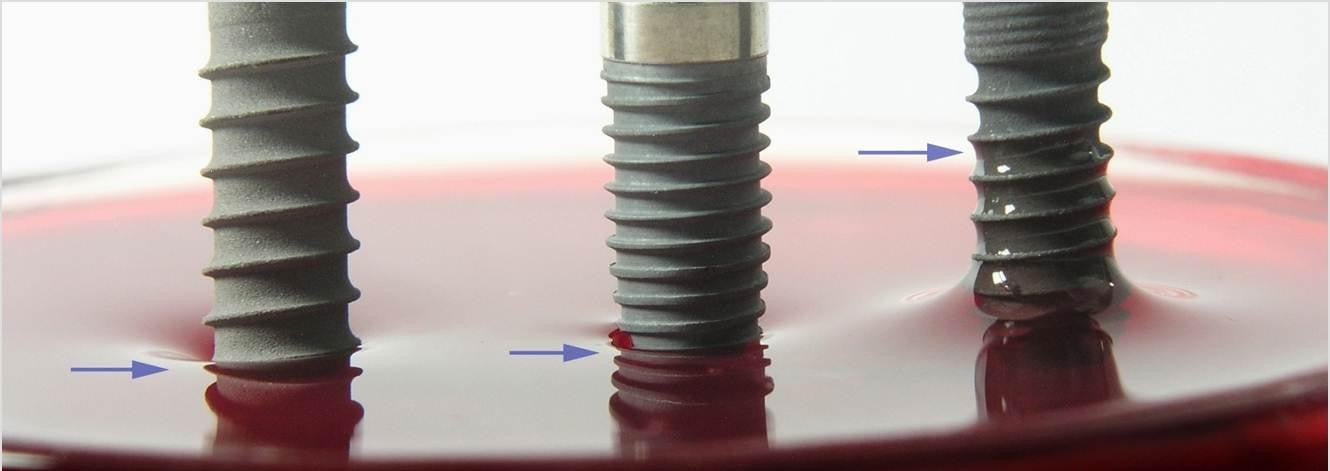 Dental Implant Design: The Blueprint for Long-Term Clinical Success