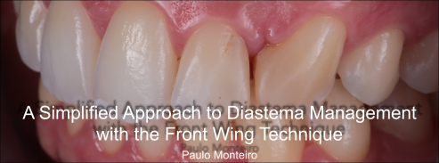 Diastema Management: The Front Wing Technique for Closing Gaps Between Teeth