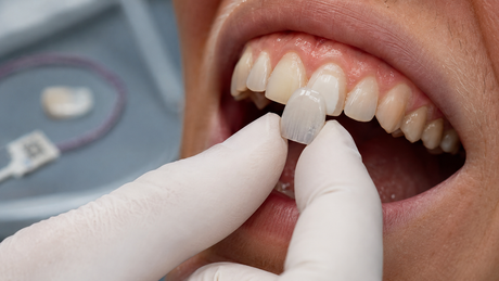 Dentist placing a porcelain veneer on a front tooth during a clinical try-in.