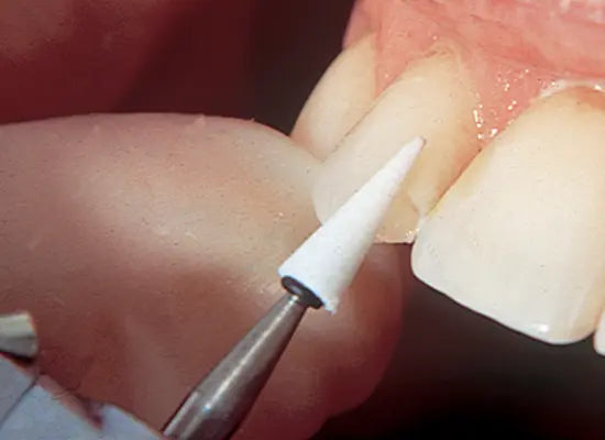 Shofu Dura-White Stones