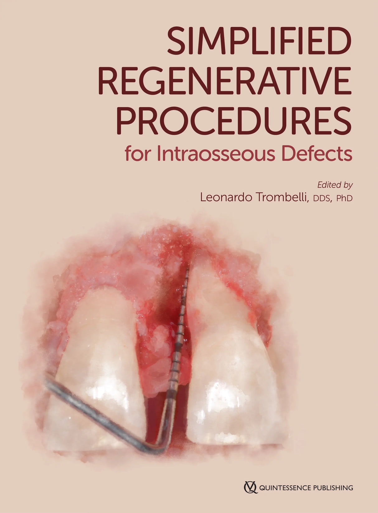 Simplified Regenerative Procedures for Intraosseous Defects 2020