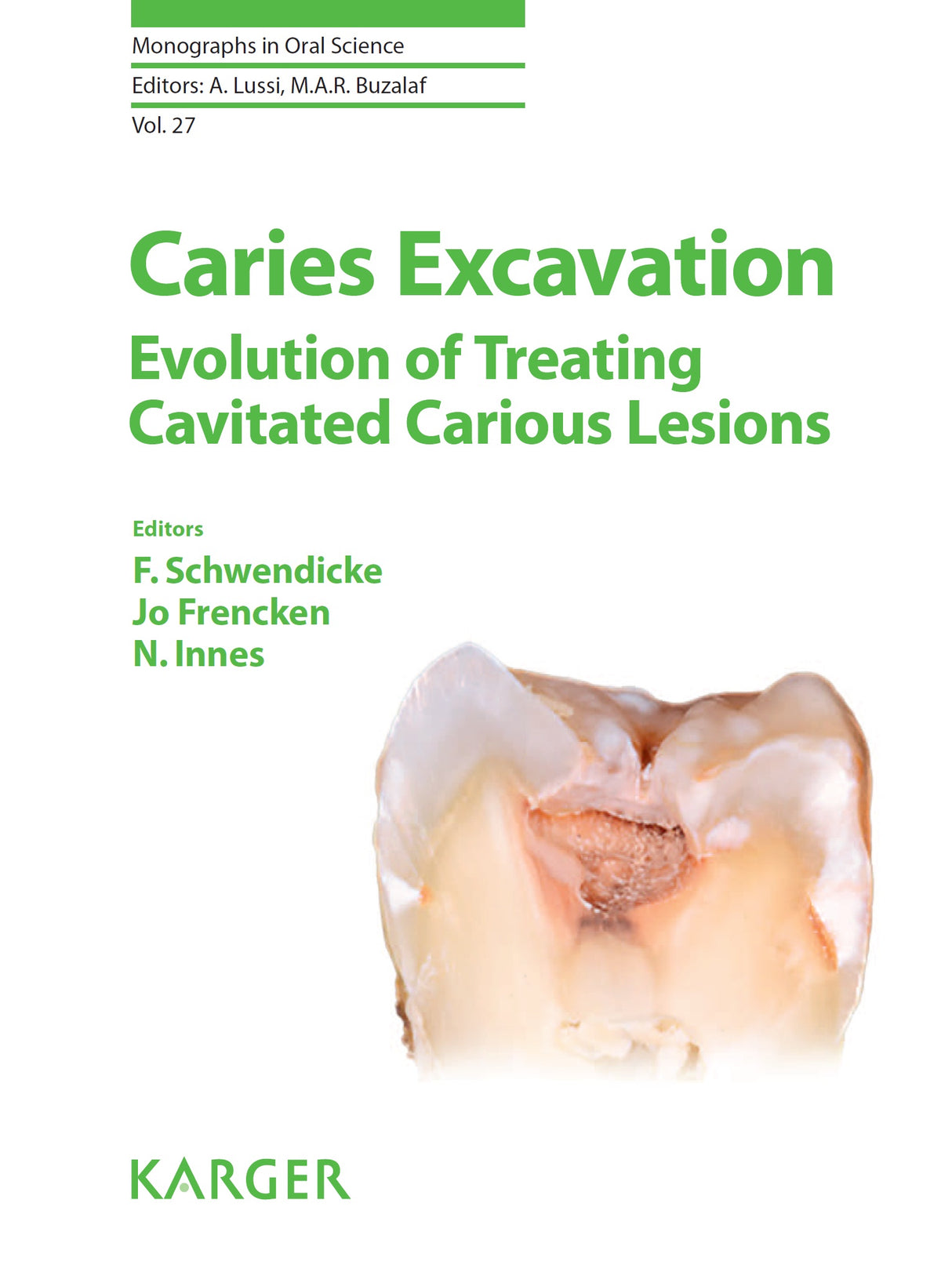 Caries Excavation Evolution of Treating Cavitated Carious Lesions 2018