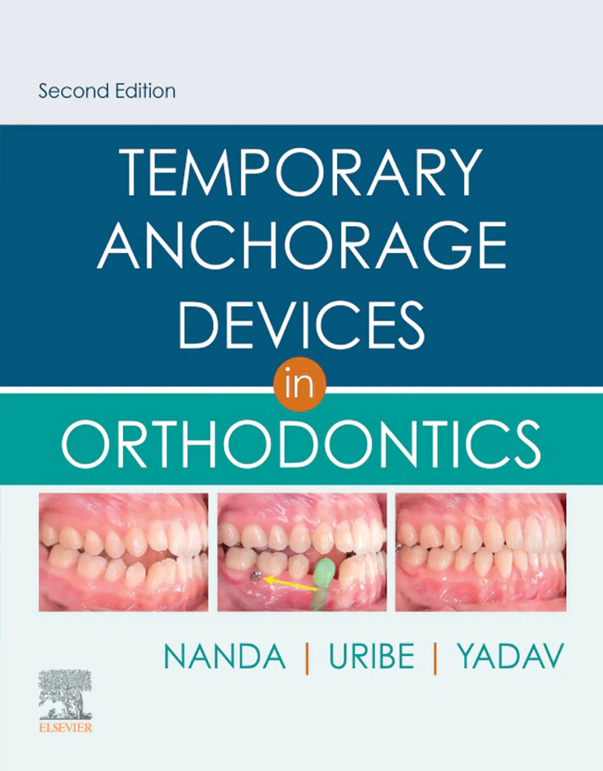 Temporary Anchorage Devices in Orthodontics 2020