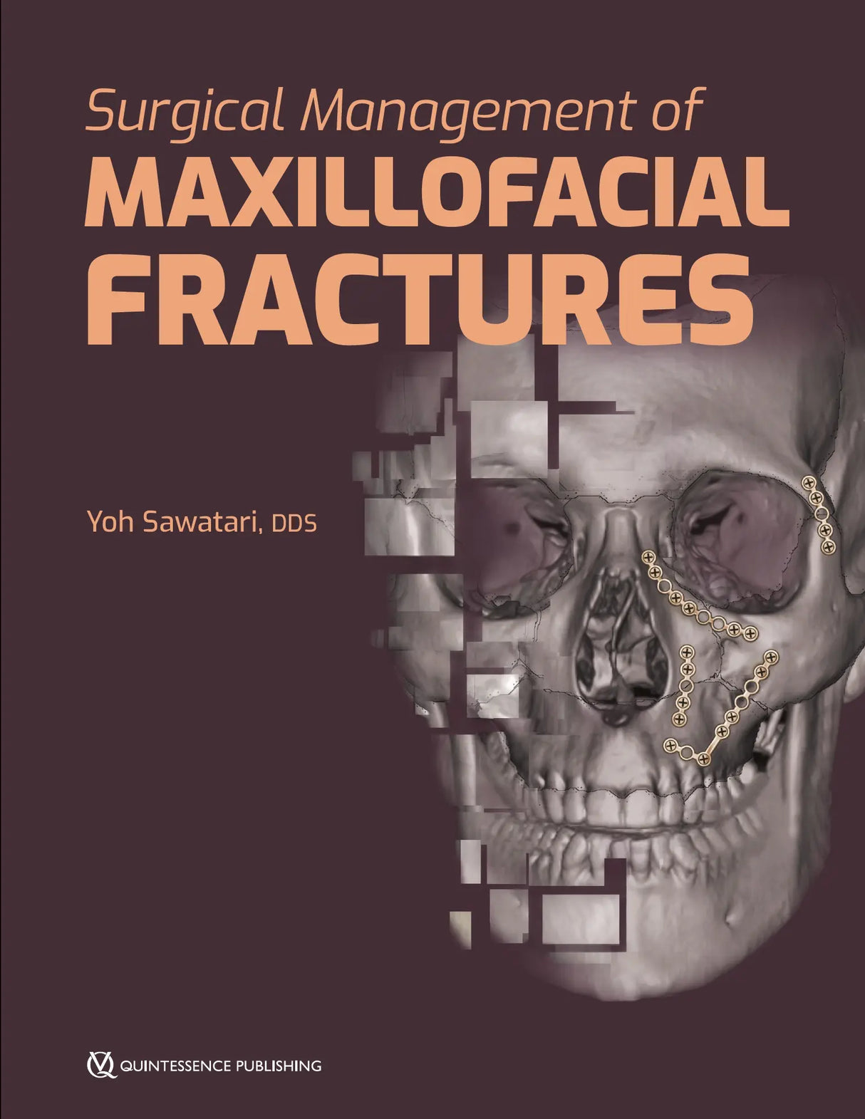 Surgical Management of Maxillofacial Fractures 2019