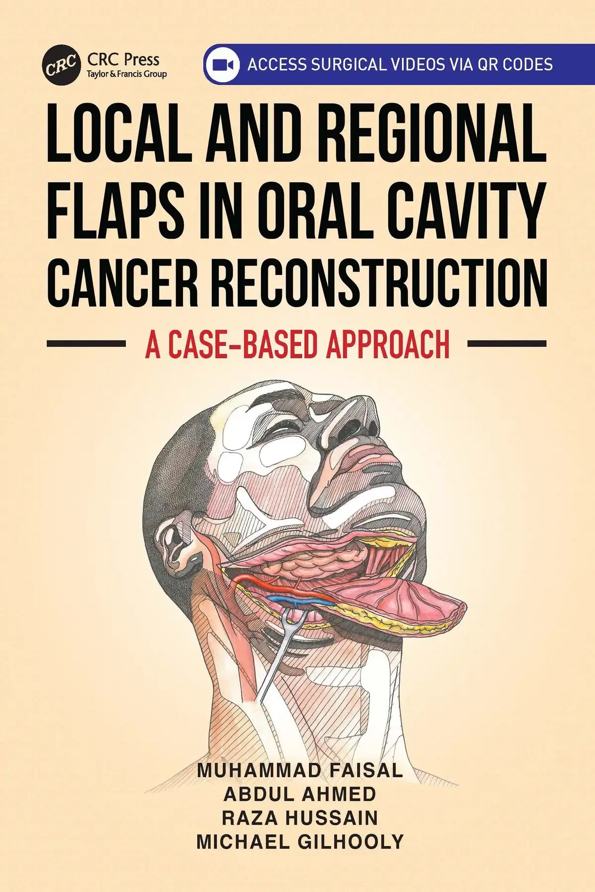 Local and Regional Flaps in Oral Cavity Cancer Reconstruction 2026