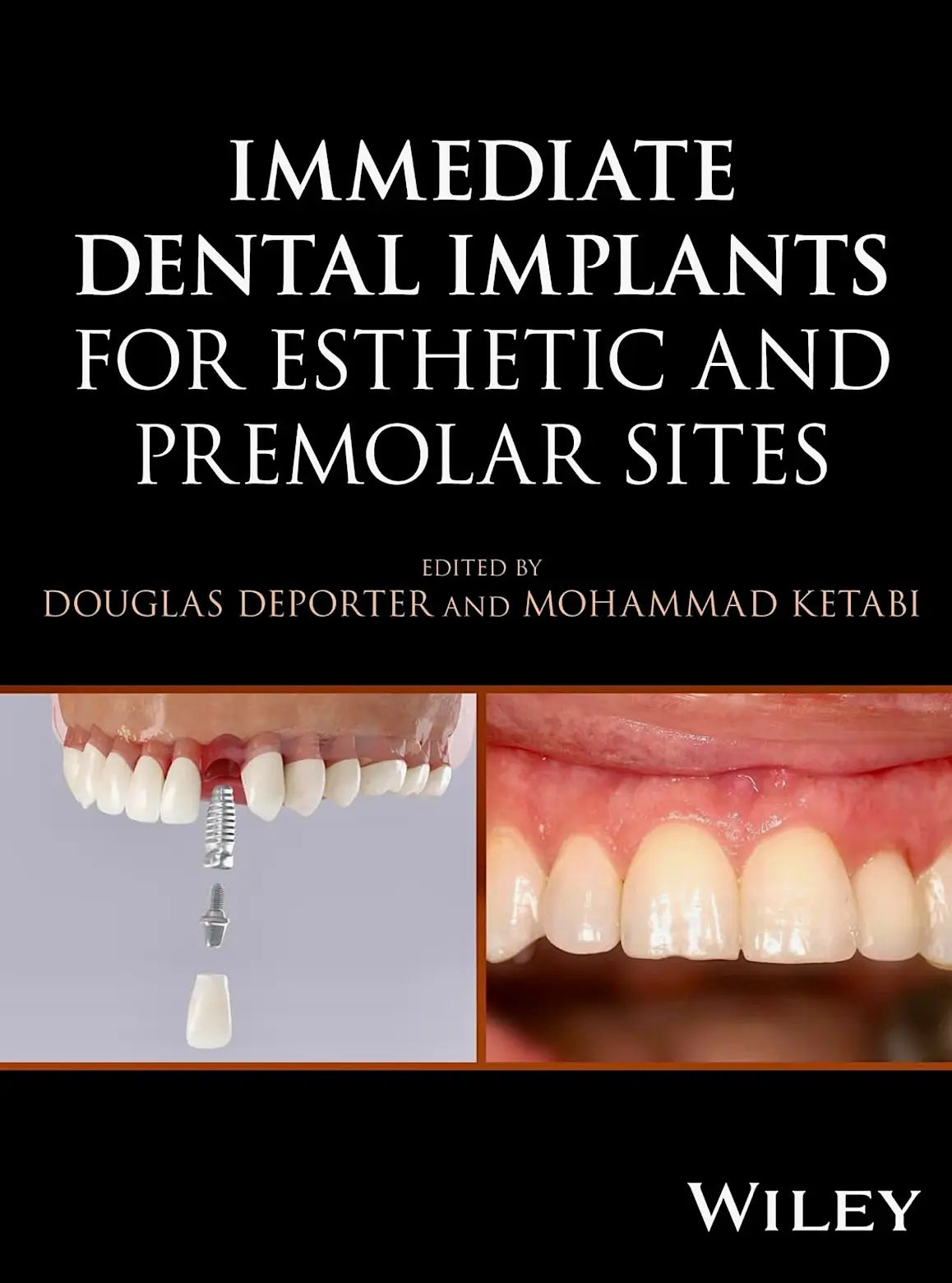 Immediate Dental Implants for Esthetic and Premolar Sites 2025