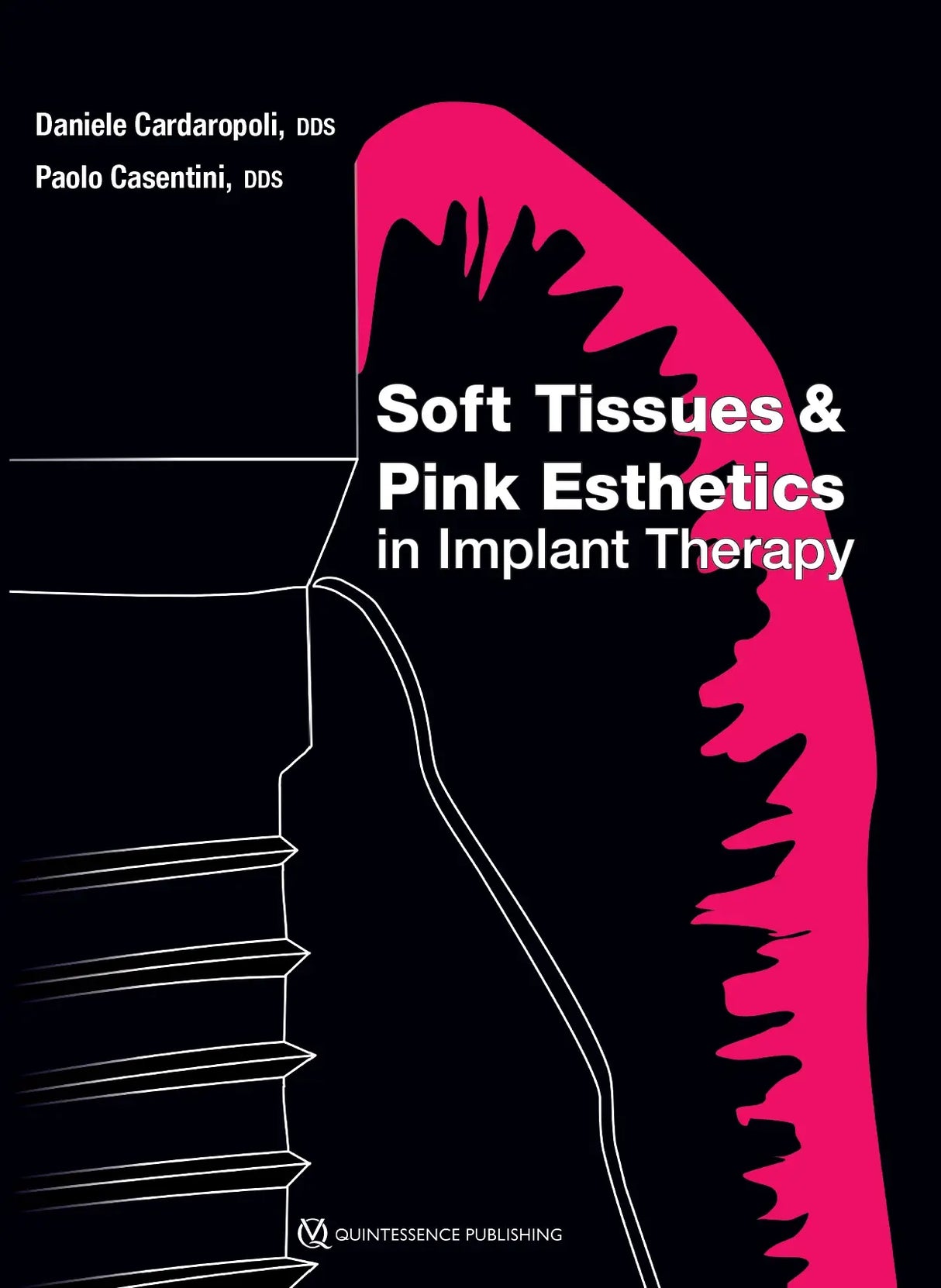 Soft Tissues and Pink Esthetics in Implant Therapy 2020