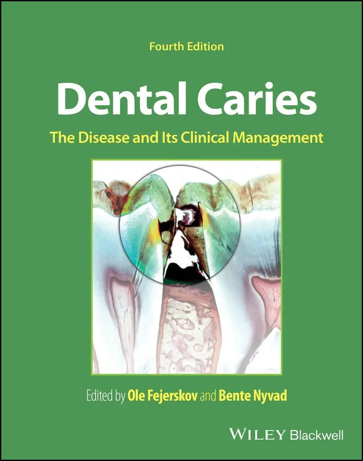Dental Caries The Disease and Its Clinical Management 2025