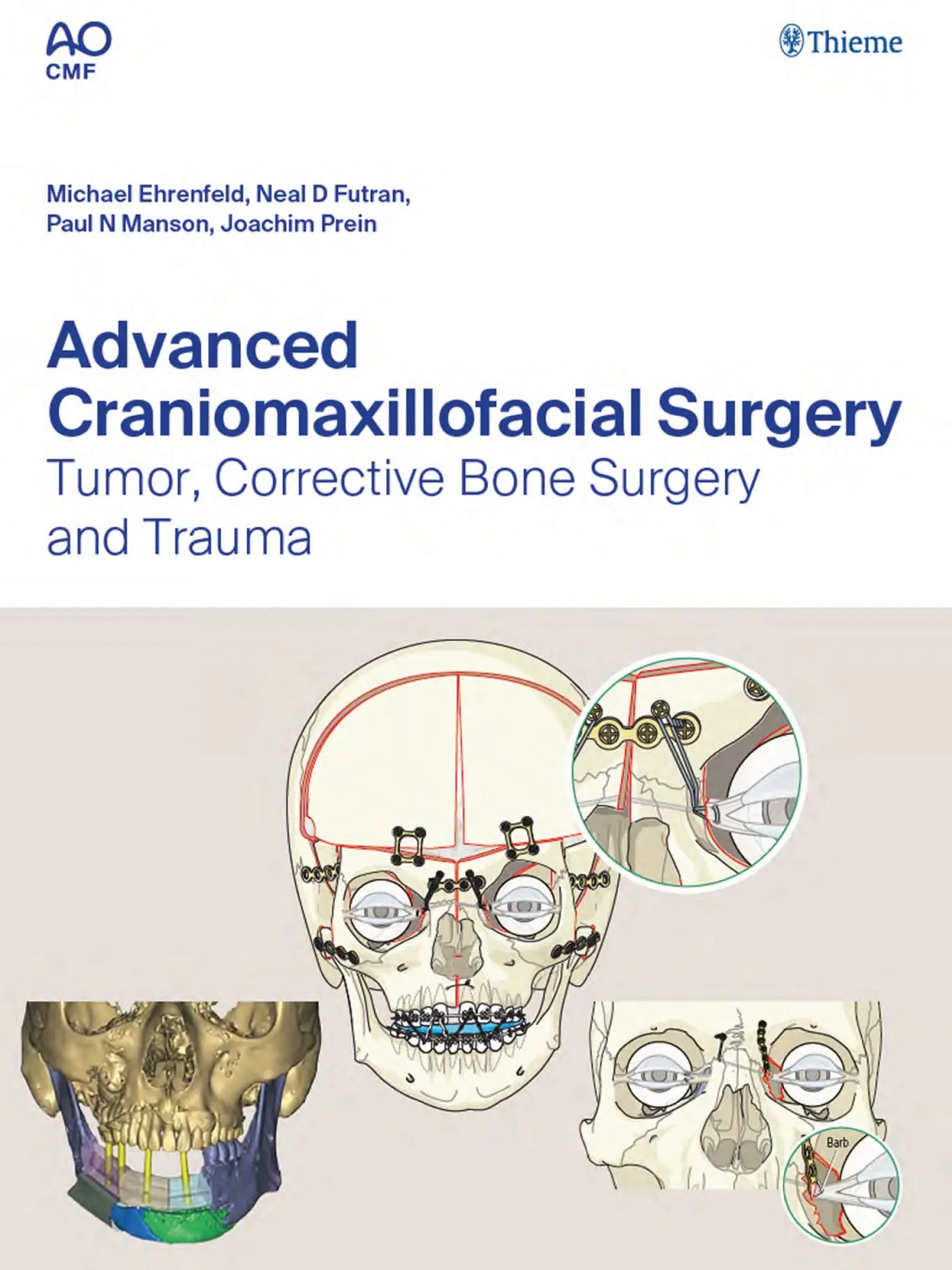 Advanced Craniomaxillofacial Surgery Tumor, Corrective Bone Surgery and Trauma 2020