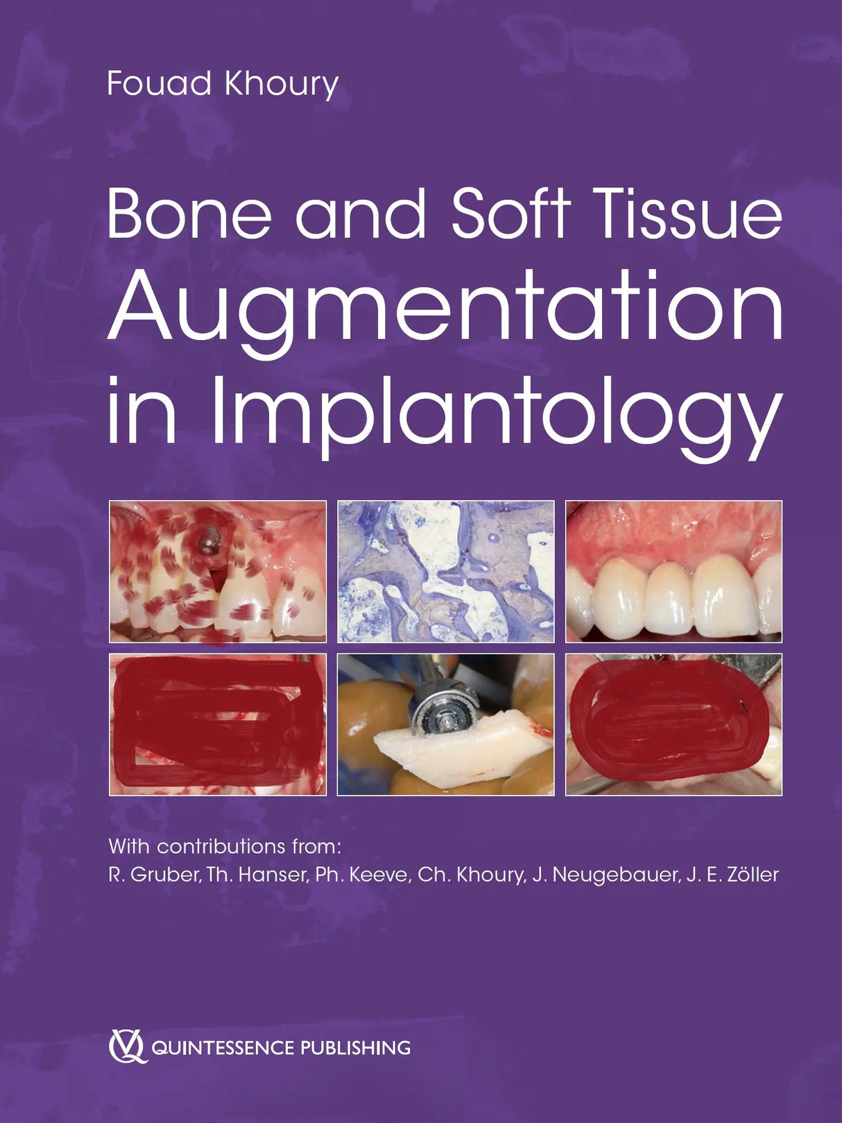 Bone and Soft Tissue Augmentation in Implantology 2022