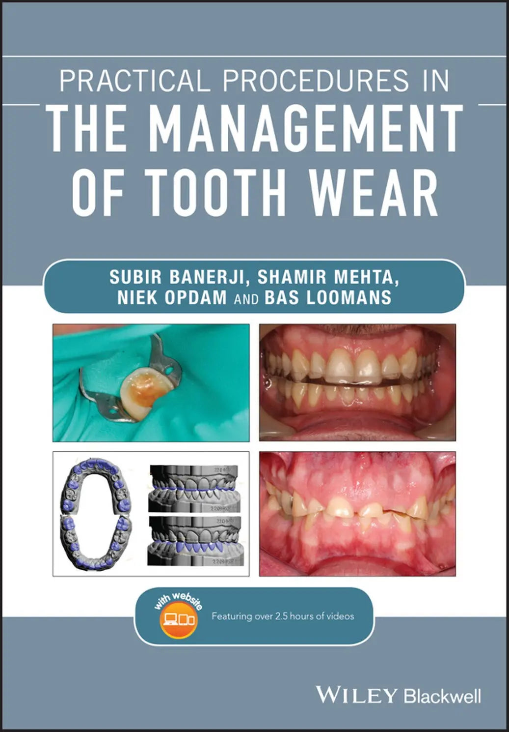 Practical Procedures in the Management of Tooth Wear 2020
