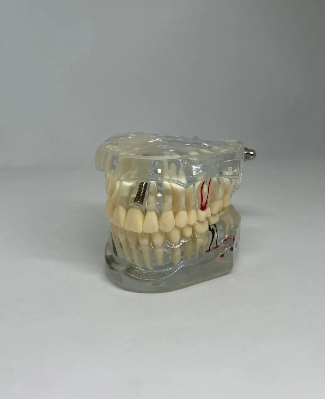 Dental Implant & Bridge Demonstration Model with Multiple Oral Pathologies