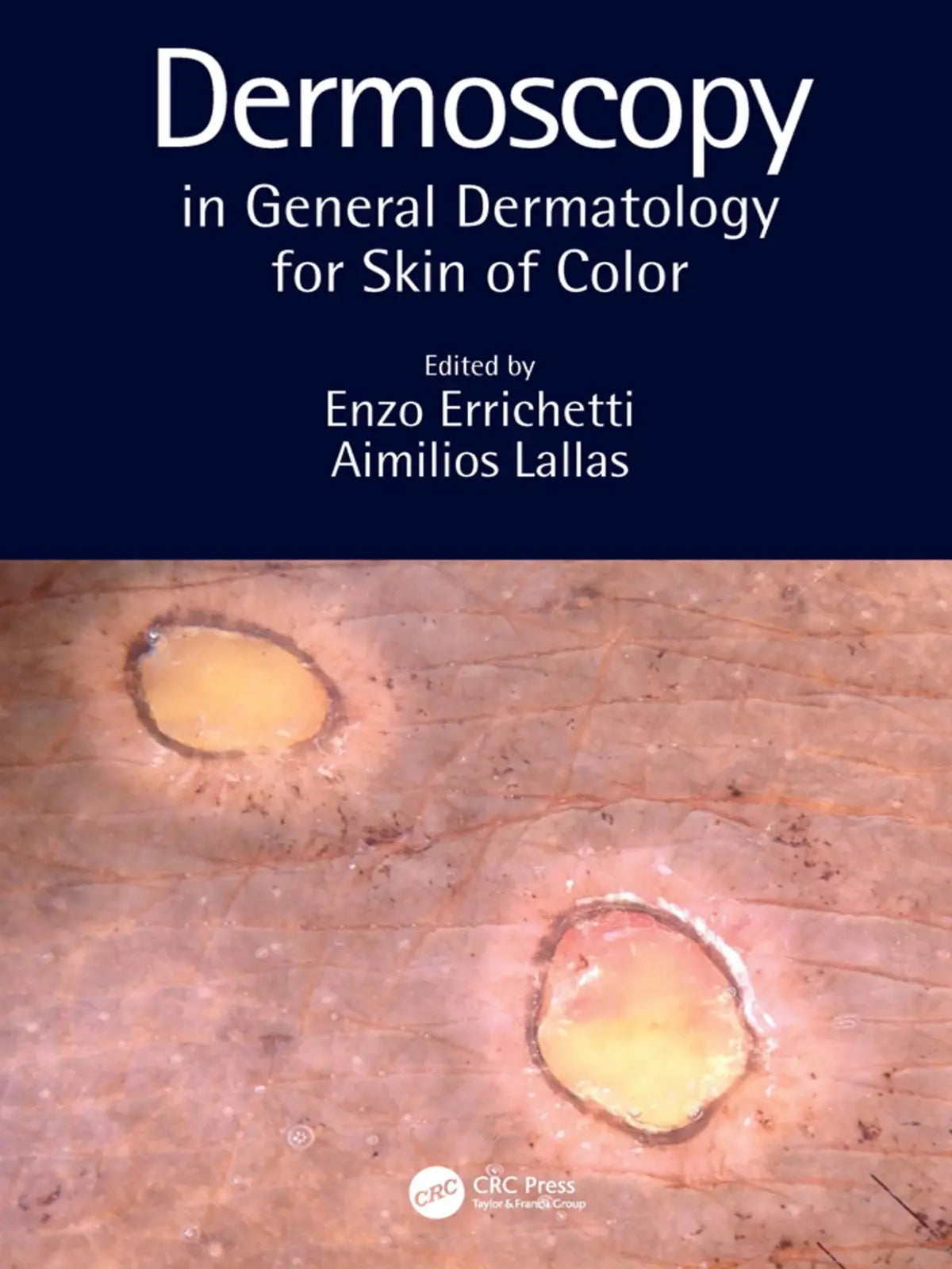 Dermoscopy in General Dermatology for Skin Color 2022